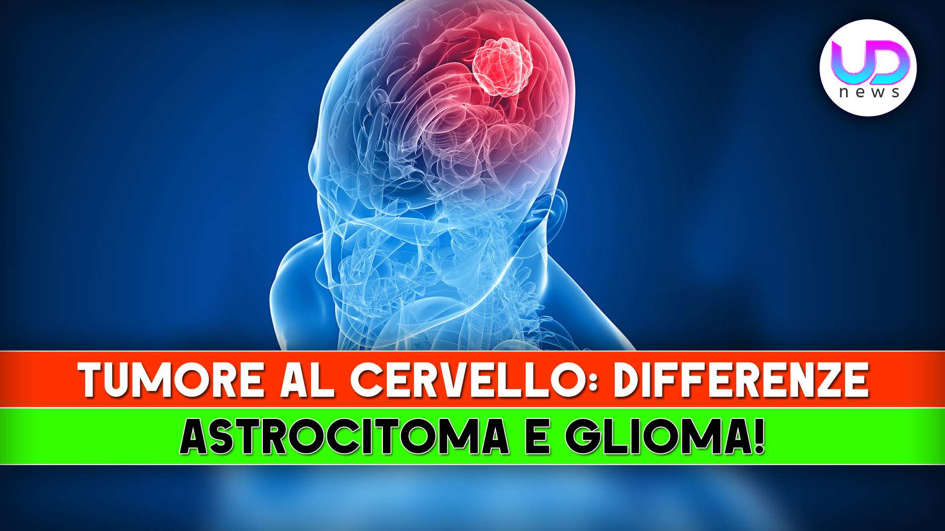 Differenze tra astrocitoma e glioma tumor al cervello guida completa Differenze tra astrocitoma e glioma tumor al cervello guida completa