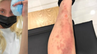 Paura durante il concerto della star morsa da un ragno velenoso ricoverata d’urgenza